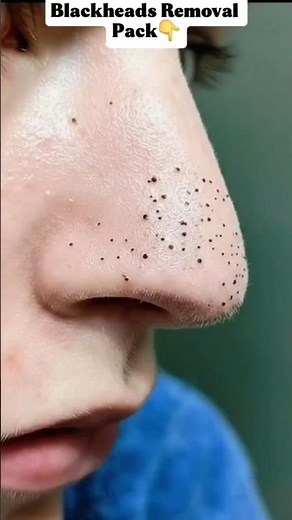 Nose Blackheads & Whiteheads Removal Pack. #NoseBlackheads #PoreCleaning #Skincare