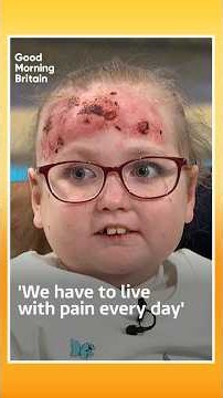 ‘We have to live with pain every day’: Living with ‘Butterfly Skin’ #eb #butterflyskin #souness