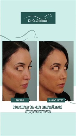 Secondary ultrasonic rhinoplasty