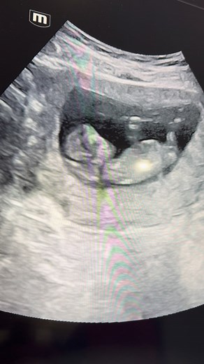 ❤️Seeking RN Nurse or RDMS (ultrasond tech) for 20 hours/week. Job duties: pregnancy tests and ultrasounds. Highlights of the position: • Paid training for ultrasound • Starting pay $30/hr, increasing to $35/hr upon completion of training Help us save lives! Please send resume and cover letter to brenda@cpcgwd.org | Crossroads Women's Center