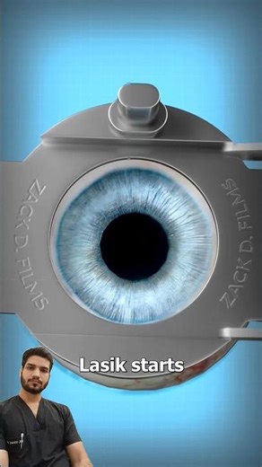 Lasik Eye surgery (3d Animation)👨‍⚕️⚕️
