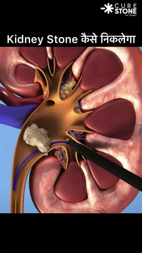 They Pull HUGE Kidney Stones Out Like THIS?! 🤯 (PCNL )