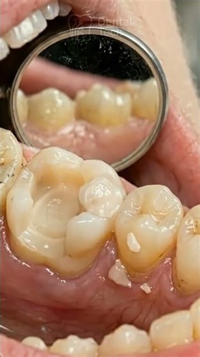 The Anatomy of a Perfect Molar: Intricate and Resilient. #dentist #asmr #dentalanatomy