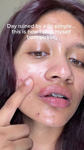 lip pimples are actually the hardest to leave alone. I used to pick them constantly and wonder why they took forever to heal. this time I just patched it and left it alone. took 2 rounds, but it flattened without me messing with it. still learning to stop touching my face tbh 🩹 #pimplepatch #acnepatch #acneproneskin #acneskin #lipacne