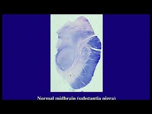 Pathology of Dementia, Degenerative and Spinal Cord Diseases