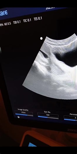 Please Your dx On This Obsteteic Ultrasound Focus On The LOwer Segment Of Utres(cervix) | Ultrasound learnig and knowledge sharing