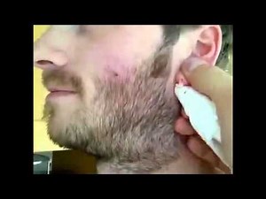 Ear Cyst Surgery