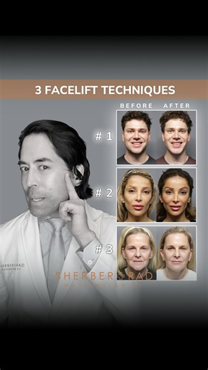 Ariel N. Rad, M.D., Ph.D., F.A.C.S. on Instagram: "Facelifting in the modern age is incredibly powerful and versatile to help patients of all ages. Here’s my breakdown of techniques that I use routinely to give patients optimized results: 1️⃣ “Endoscopic” methods involve small, hidden incisions in the temple, scalp, post-auricular (behind the ears) and sometimes under the chin through which I lift, sculpt and shape SMAS and platysma without removal of skin. This stealth facelift technique is opt