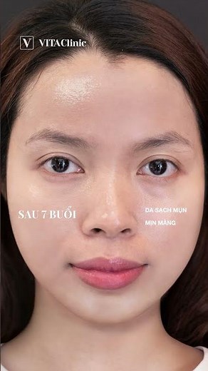 Laser Skin Health x BS Loan Lê – Vì sao được bác sĩ đánh giá là giải pháp điều trị mụn hàng đầu?