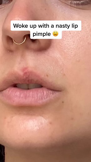 Saying Goodbye to Pimples: Effective Acne Treatment Tips