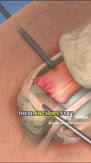 Understanding Rotator Cuff Repair Surgery