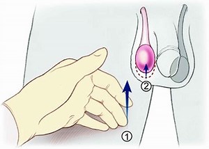 Cremasteric reflex definition & cremasteric reflex test