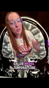 Case Study 153 - Mesial temporal lobe epilepsy Mesial temporal lobe epilepsy (MTLE) affects the inner part of the temporal lobe manifesting in the hippocampus, parahippocampal gyrus and the amygdala. MTLE is the most common type of epilepsy and is often characterized by the sense of an aura immediately preceding the seizure. #sundaycasestudy #ladyspinedoc #healthcareworker #hospital #surgery #neurosurgeon #medicalschool #medstudent #medicalstudent #nursing#Epilepsy #EpilepsyAwarenessMonth #Seizu