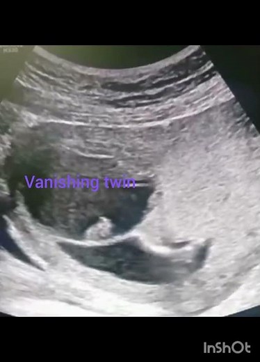 Twins on ultrasound 🥳 (vanishing twin )