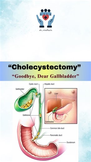 Dr. Nazmul_PT on Instagram: "Cholecystectomy safely removes a problematic gallbladder and brings lasting relief from pain and digestive discomfort. . . . #Cholecystectomy #GallbladderSurgery #Gallstones #DigestiveHealth #LaparoscopicSurgery #MedicalAwareness#nhvitalfacts"