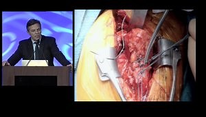 When & Why To Add a Tendon Transfer to a Reverse Shoulder Arthroplasty