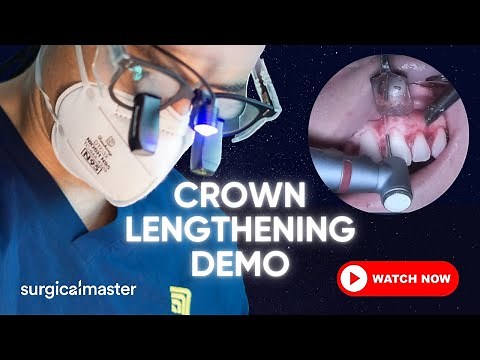 Crown Lengthening Demo