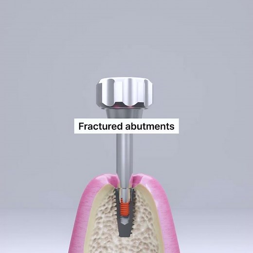 Remove Problematic Dental Implant