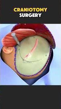 craniotomy surgery