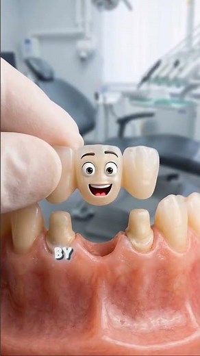 Implant vs Bridge vs Crown