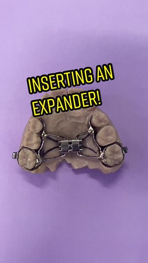 How we insert a palatal expander and how you activate it! #thesmilepatio #orthodontics #orthodontist #braces #braceson #bracestips #bracestok #rpe #palatalexpander #palatalexpansion #earlyorthodontics #vistaca #vistacalifornia #GradeUpWithGrammarly