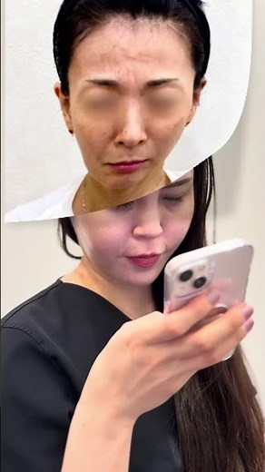 ボトックス #美容 #整形 #美容整形 #ボトックス #シワ治療