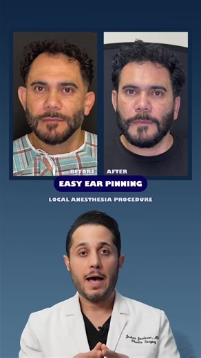 Otoplasty: Repositioning Prominent Ears for Natural Balance