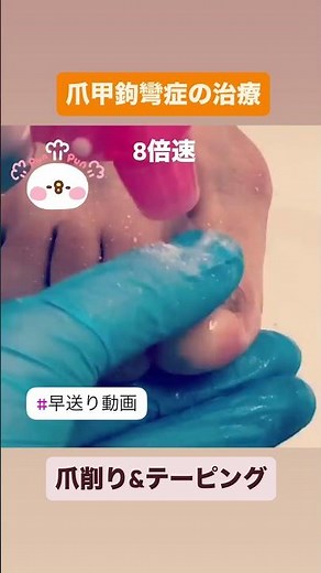 爪甲鉤彎症の治療