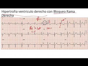 Hipertrofia Ventriculo Derecho con Bloqueo de Rama Derecha EKG