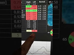 OCT Optopol Revo RNFL reporting.