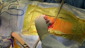 THA - Direct Anterior Approach MAKOplasty