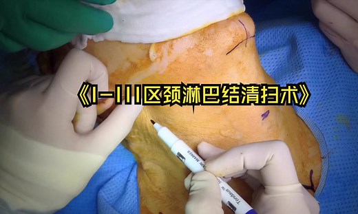 【油管转载】I-III区颈淋巴结清扫术