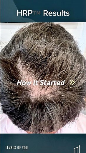 Male pattern hair loss transformation with HRP™️ #HRP™️ #DrHopkirk #hairlosstreatment #hair #health