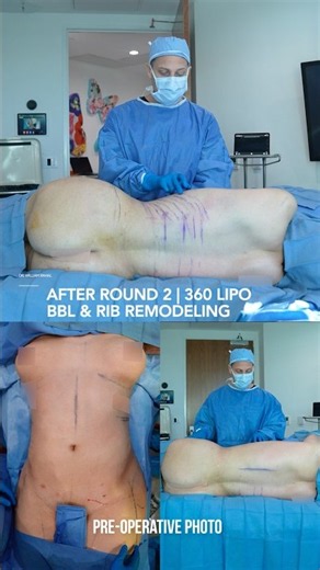 Rib Remodeling Surgery Before & After #ribremodeling #genderaffirmingsurgery #lipo #bbl #ribxcar