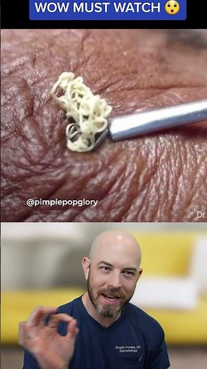 Extraction Physics: Why Tool Size Matters for Large Cysts