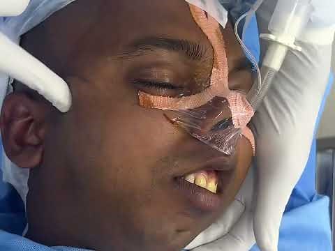 TMJ Ankylosis step wise surgery showing 40 cm mouth opening via Interpositional arthroplasty