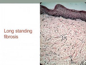 chronic inflammation lecture