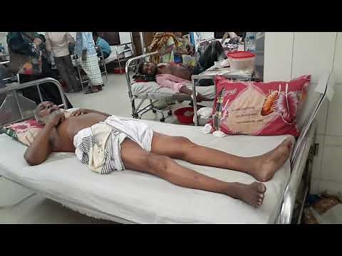 Hemichorea- hemibalism