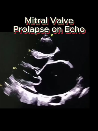 Key questions to ask during your assessment: • Do you visually suspect prolapse on 2D imaging? • Can you measure >2 mm of prolapse on 2D or M-mode? • Is mitral regurgitation present, and what is the jet direction (helps determine leaflet involvement)? • Does the CW Doppler profile suggest mid-systolic MR (partial jet due to timing of prolapse)? Study smarter for your adult echocardiography boards with 1,200 practice questions, structured learning modules, and comprehensive study guides. Try it f