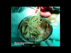 Surgical removal of worms in an Obstructed bowel at General Hospital Kalutara