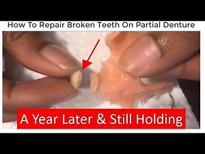 How To Repair Broken Teeth On A Partial Denture For Less Than $5 Dollars