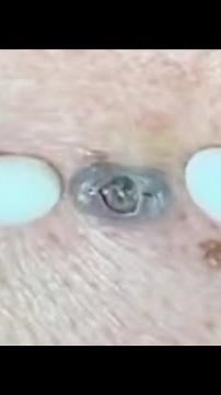 Dpow Giant Blackheads All On The Same Person Back Dilated Pore Of Winer