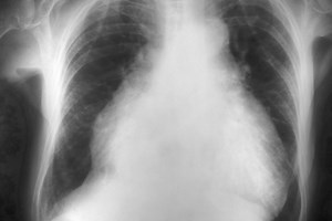 Cardiomegaly: symptoms, congenital, treatment, diagnosis by X-ray