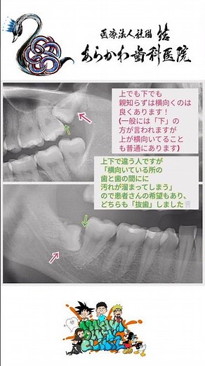 親知らずが横向き！?抜いた方が良いの? #あらかわ歯科医院