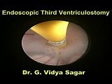Endoscopic 3Rd Ventriculostomy • Video • MEDtube.net