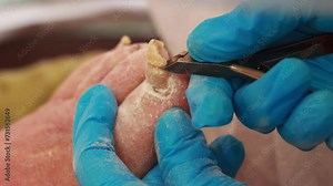 A podiatrist is biting off a toe nail with forceps from an old man. Nail care for the elderly. Close-up, slow motion