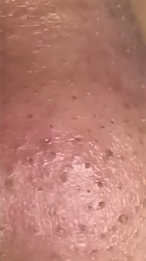 Deep Blackhead & Acne Removal | Satisfying Spa Facial Cleaning 2026 #004
