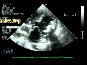 Tiger heart: A  Variant Of  Left Ventricular Noncompaction (LVNC)? • Video • MEDtube.net