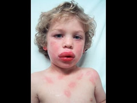Anaphylaxis and Acute Allergic reaction - How to Help