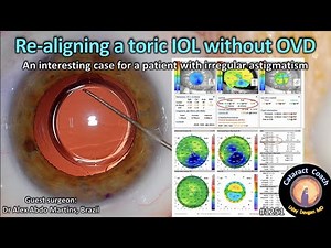 CataractCoach 1251: re-aligning a toric IOL without OVD